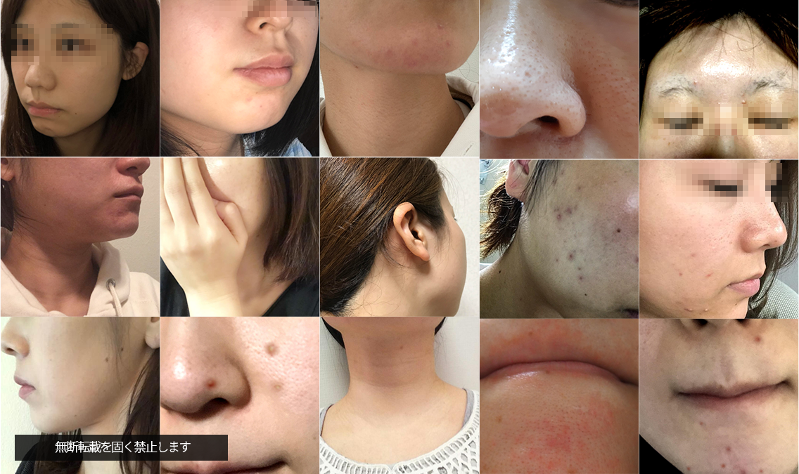 「ニキビを今度こそ治したい！」本気のおすすめニキビケア